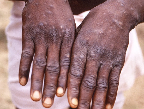 WHO Declares Monkeypox A ‘Public Health Emergency’