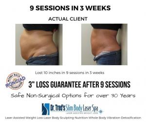 Announcing Laser Lipo Services offered in Stuart